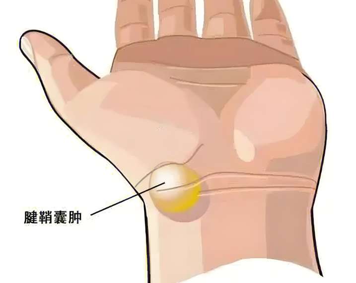 腱鞘 囊腫 自然 消失 方法​