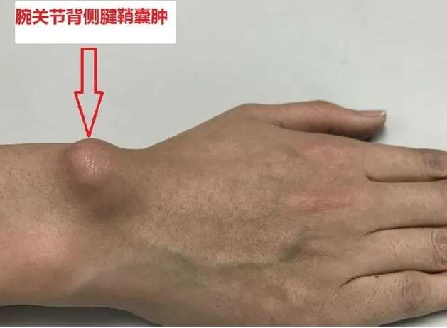 腱鞘囊腫的形成原因