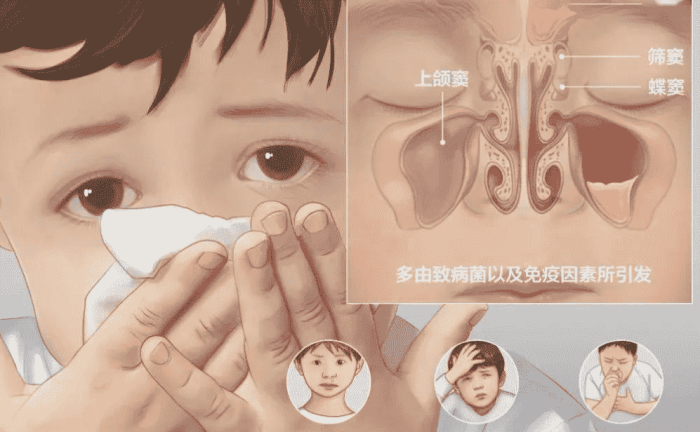 睡覺鼻塞解決方法 睡覺鼻塞解決方法
