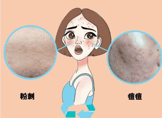 粉刺會自己消失嗎