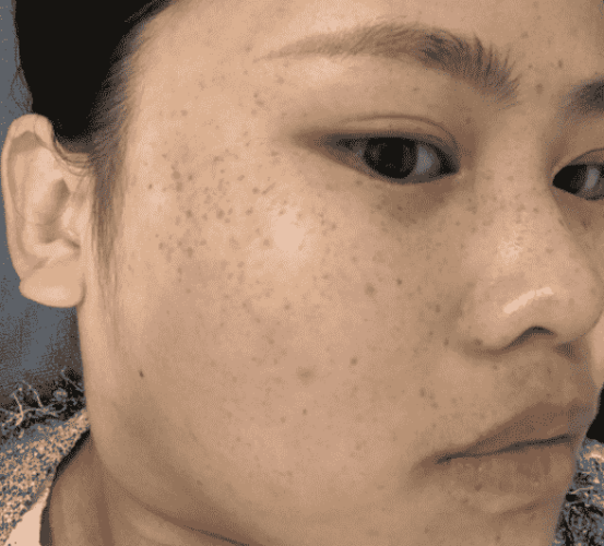 為何會有黑斑 為何會有黑斑