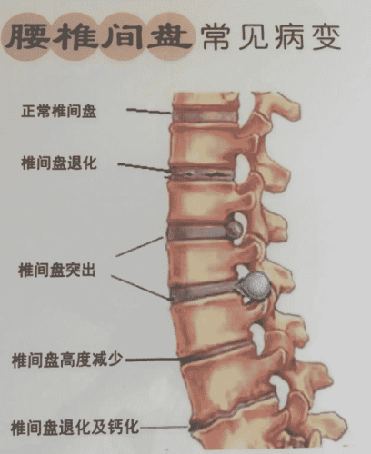 脊椎退化的原因 脊椎退化的原因