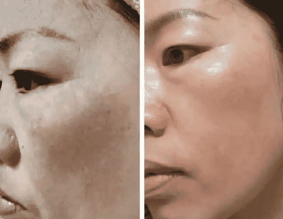 消除黑斑的有效方法 消除黑斑的有效方法