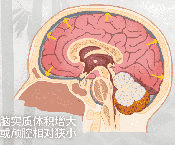 腦壓高的症狀 腦壓高的症狀