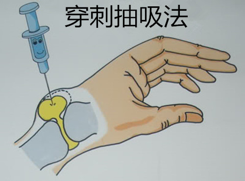 腱鞘囊腫自然消失方法