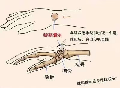 腱鞘囊腫的形成原因 腱鞘囊腫的形成原因